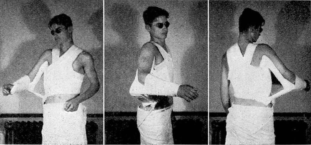 Fractured clavicle X-rays and new technique used by Dr. Outland, 1932.