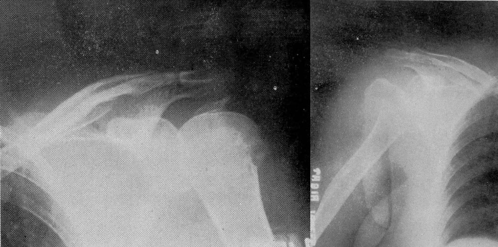 1946 X-rays showing fractures of both humeral heads and dislocation of right shoulder, resulting from an electrical shock. At the time of Dr. Hammond’s case study, there had only been a dozen cases of the kind recorded.