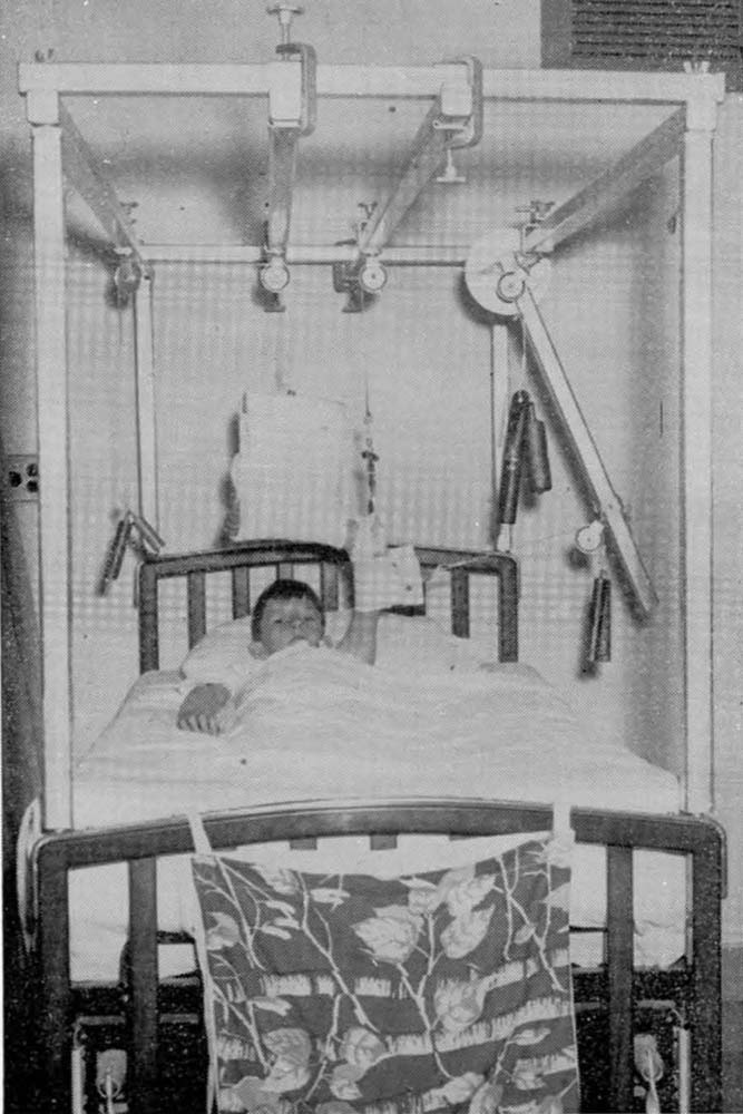 Kirschner wire skeletal suspension traction in use, 1949.