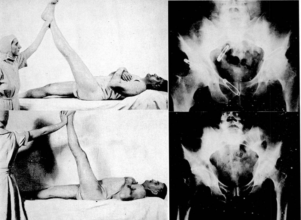 Photos from Chief Dr. Paul Harmon’s 1941 study on hip arthroplasty using lucite cups. Post-operative photo shows 20 degree increase in range of motion.